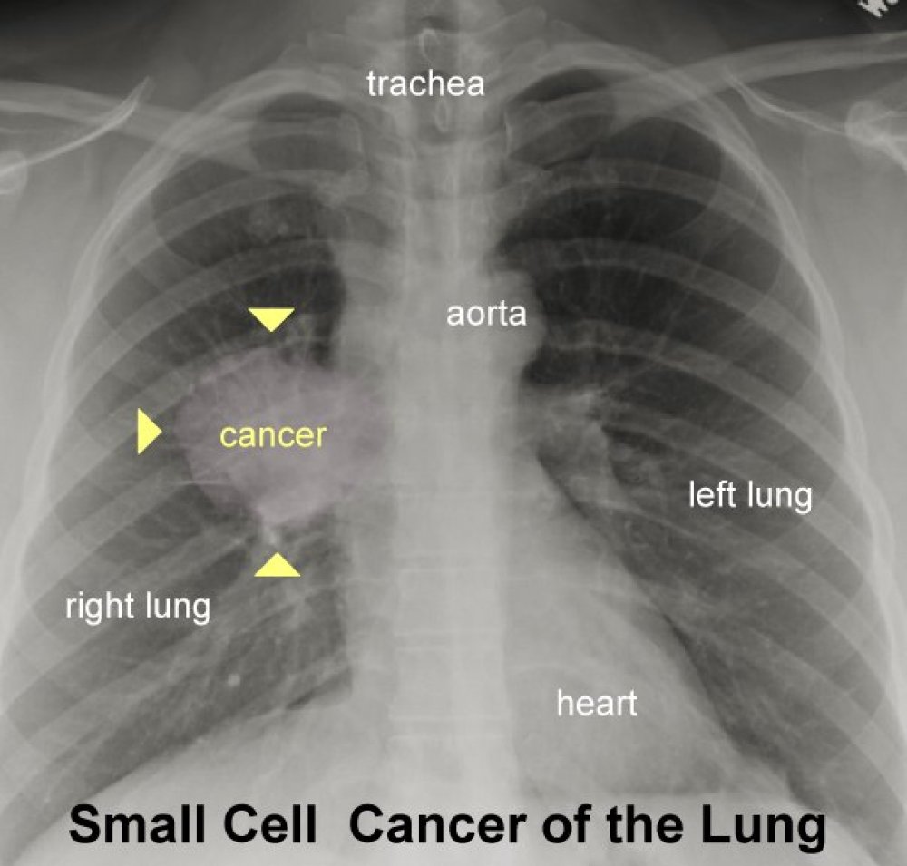 5 Smoker's Lungs Pictures That Will Shock You New Health